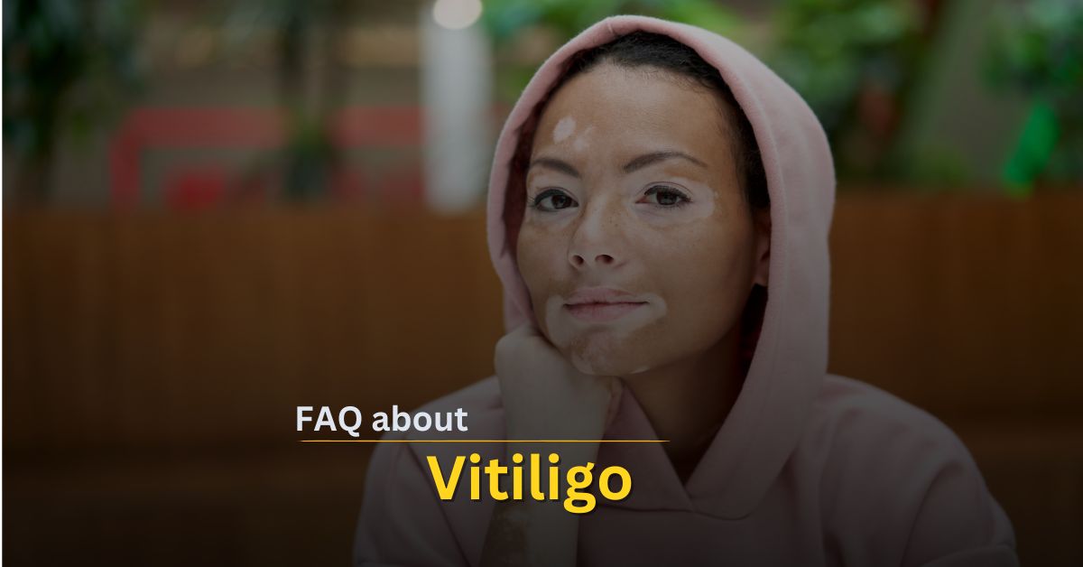 FAQ about Vitiligo